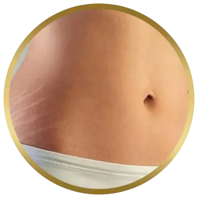 Ello Clínica Dermatologia Rio de Janeiro - Estetica Barra da Tijuca - Tratamento de estrias com sérum